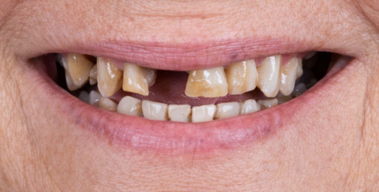 Sonrisa antes del tratamiento de implantes