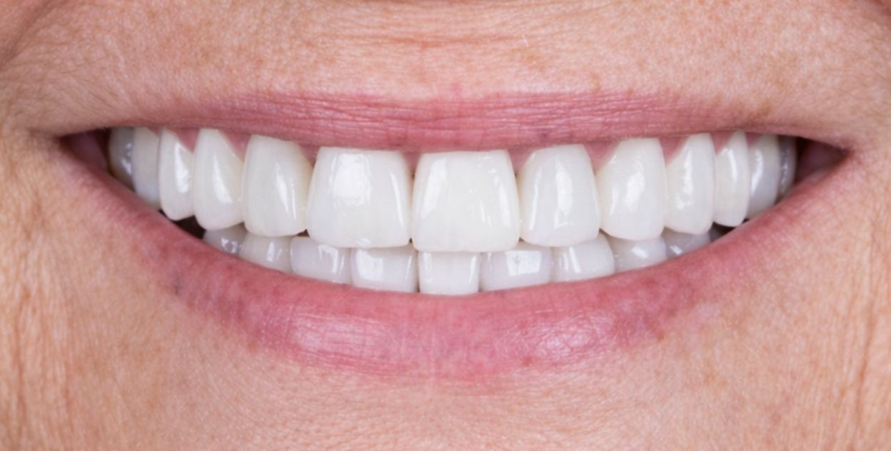 Sonrisa después del tratamiento de implantes