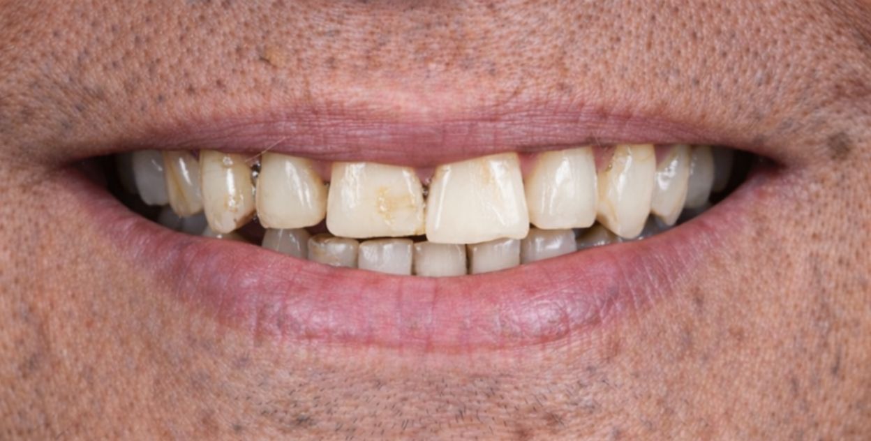 Boca antes de colocar los implantes dentales