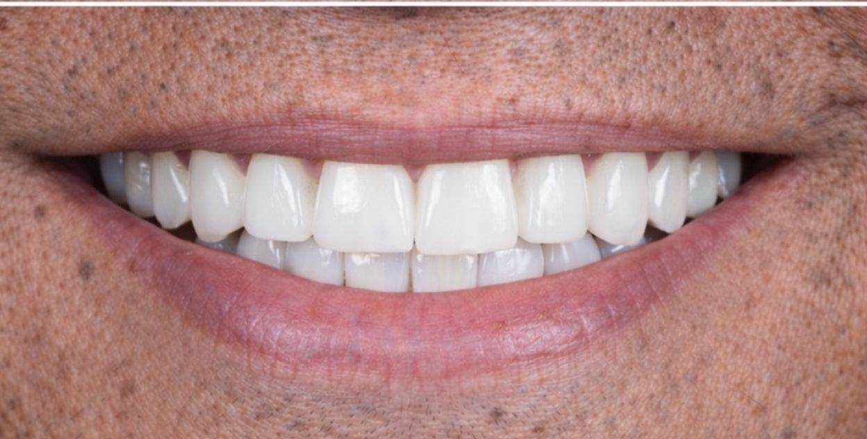 Boca después de colocar los implantes dentales