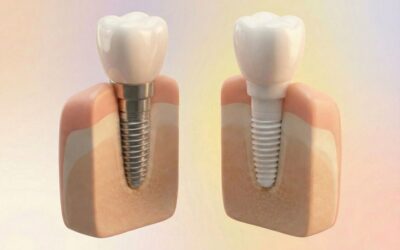 ¿Qué es más caro, el implante de titanio o el implante zirconio?