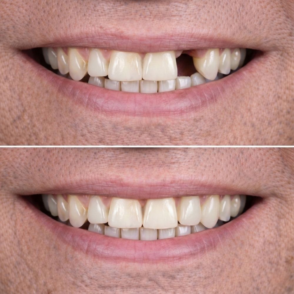 implante dental una pieza precio