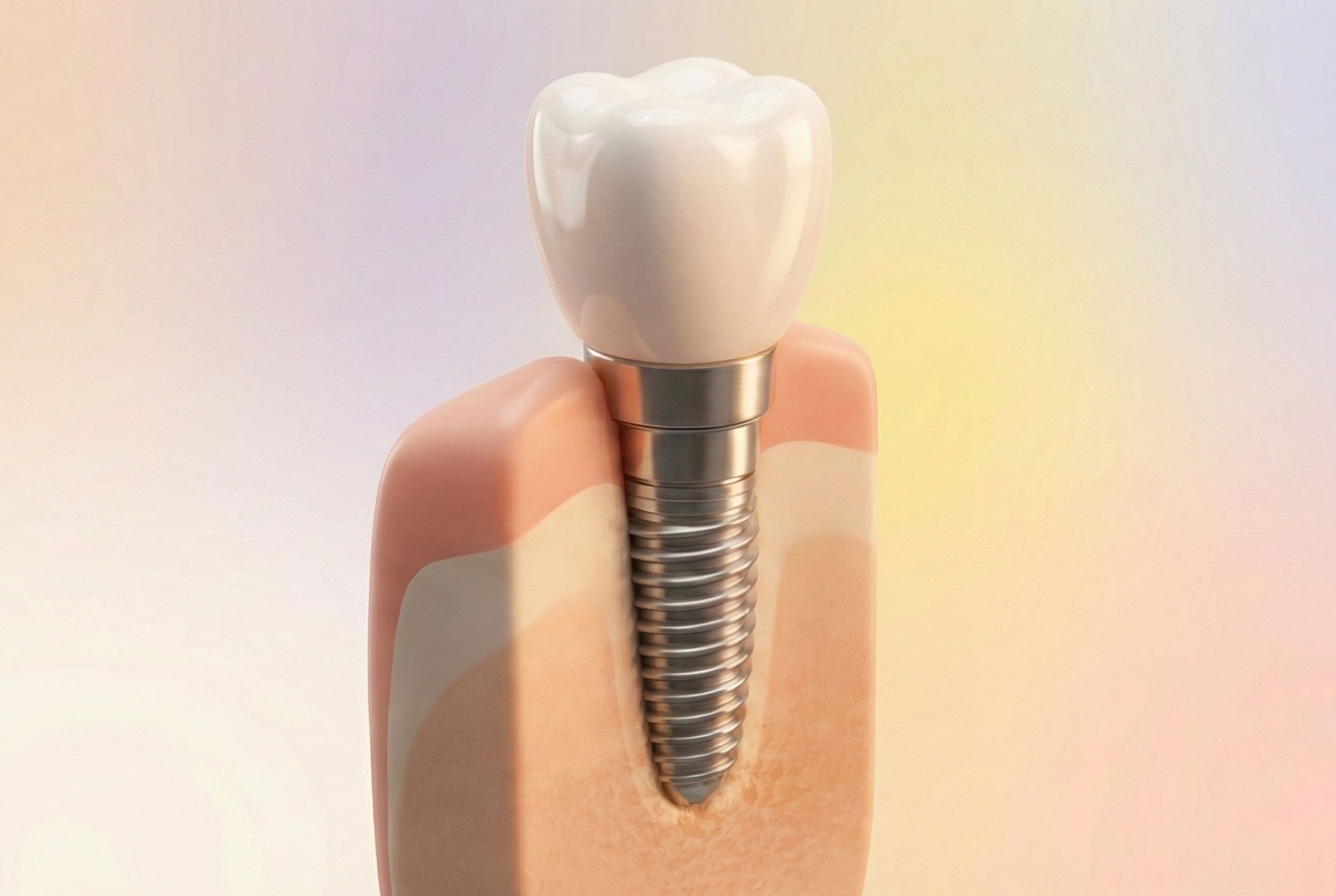 tipos de implantes dentales